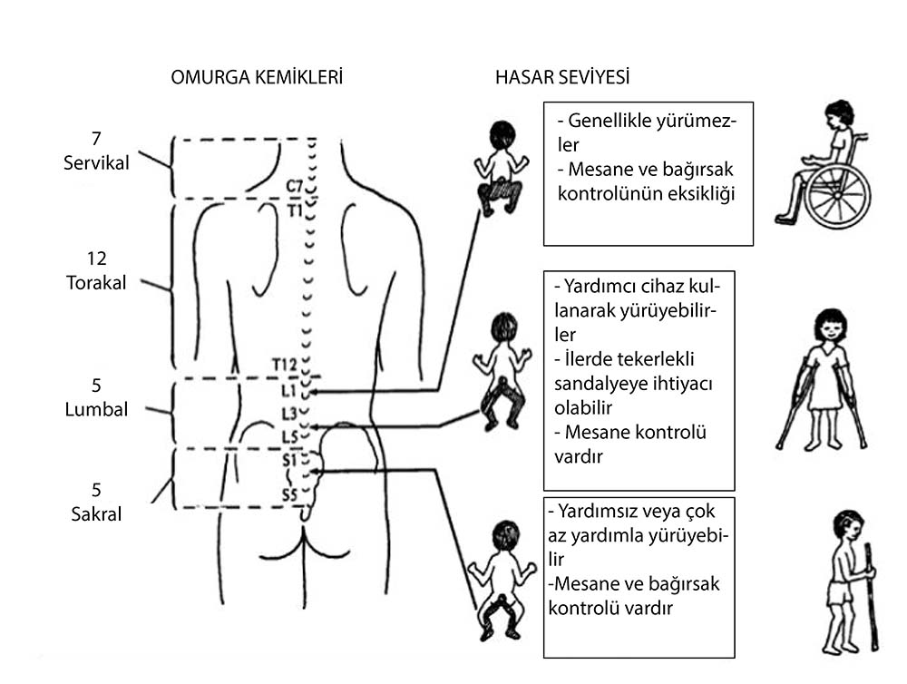 Spina Bifida